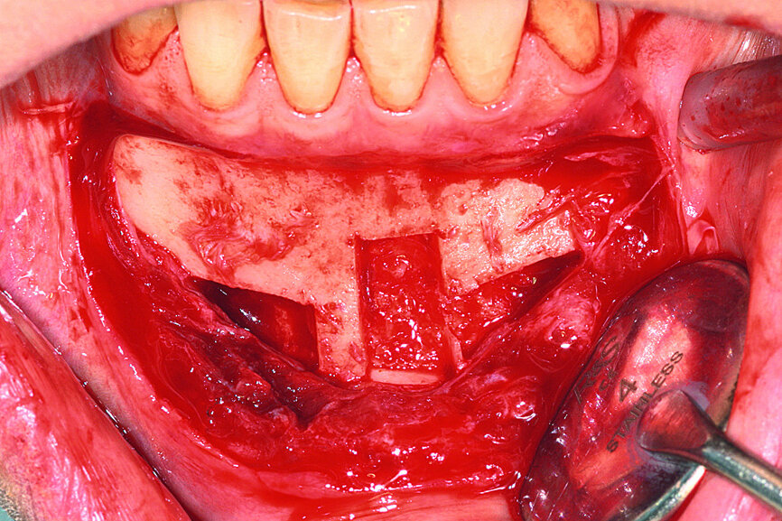 Fig. 6: The grafts were harvested from the chin symphysis and firmly attached by surgical screws in the recipient site.