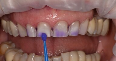 Làm sạch các phục hình răng cố định không có kim loại trước khi thực hiện các thủ thuật liên kết