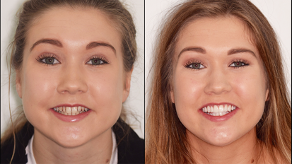 A combined digital orthodontic and restorative approach