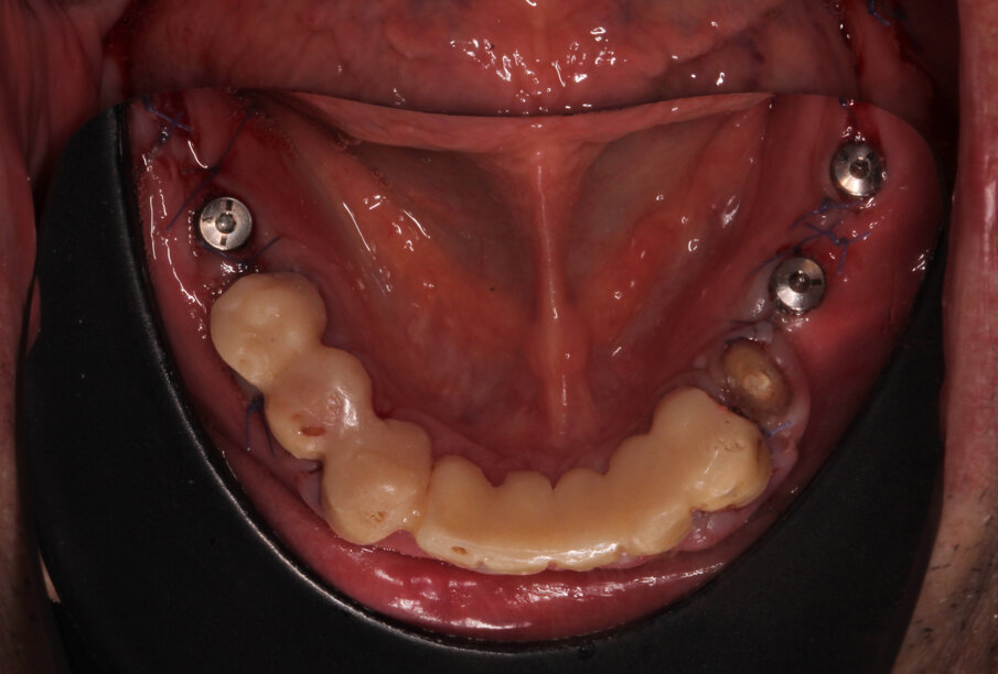 Fig. 12: Implant abutments in situ
