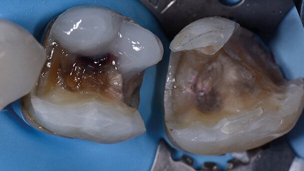 Restauri diretti complessi  in composito Ormocer nella  regione posteriore. Caso clinico