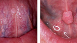 Fig. 3. Condilomas. Son lesiones que se pueden presentar en la mucosa oral, su apariencia es blanda con una superficie parecida a la coliflor.