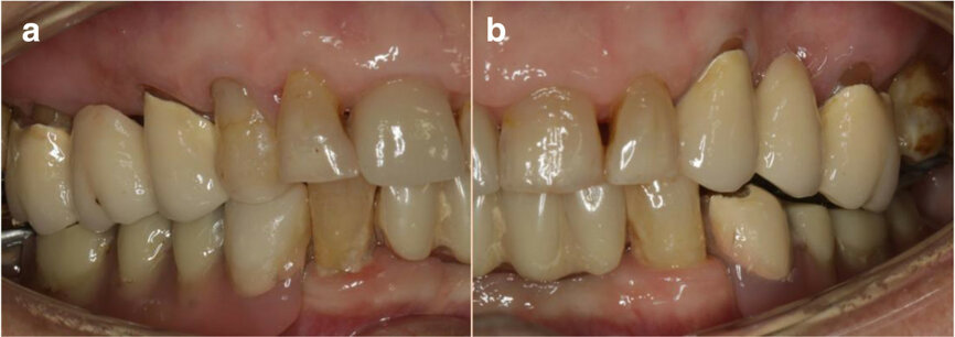 Figs. 2a & b: Initial dental status: right side (a) and left side (b).