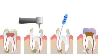 Novi endodontski tretman koji će zameniti klasičnu endodonciju