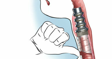 Implantation du premier larynx artificiel chez l’homme