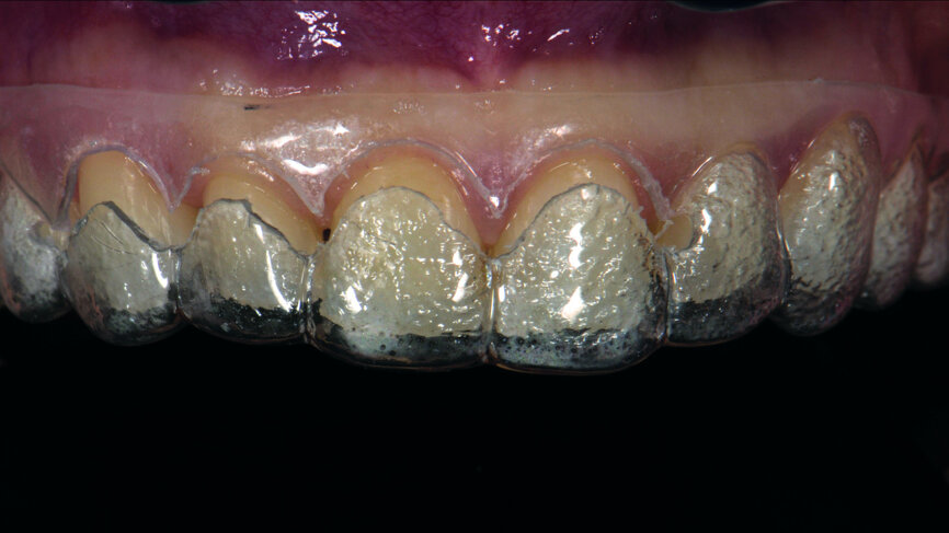 Figs. 6a: Intraoral fi t of the surgical guide for crown lengthening.
