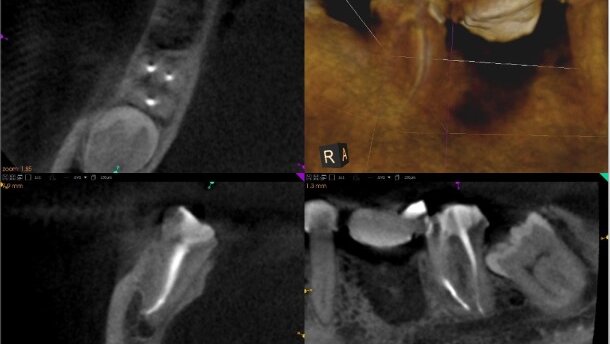 Efektywność wypełnienia kanałów w leczeniu endodontycznym z zastosowaniem CBCT