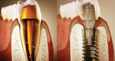 Zpět k počátku… Část II: Endodonticko-implantologický algoritmus založený na důkazech