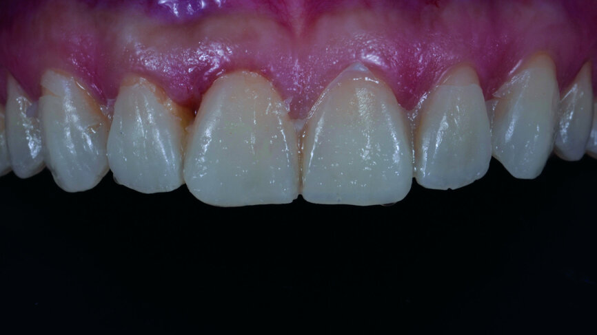 Fig. 8b: Intraoral photograph of the mock-up.