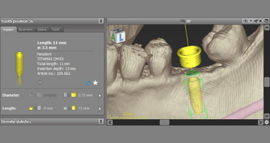 Dental Wings integra implantes da Neodent em software de cirurgia guiada