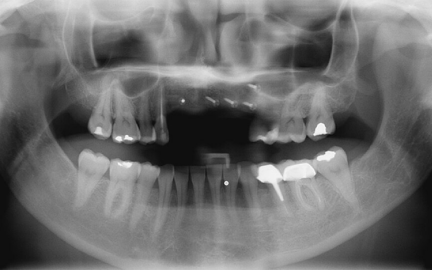 Fig. 10: Panoramic radiograph showing the grafts to be correctly healed and satisfactorily adhered to the recipient bone sites.