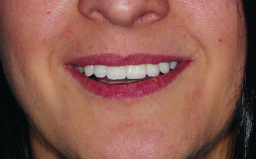 Fig. 38: Final cosmetic check-up showing correct lip support with the new extremely reduced false gingiva.
