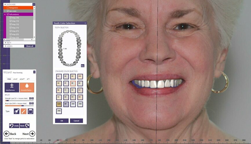 Fig. 14: 3D smile design simulation.