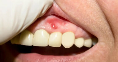 Glede na novo študijo togost dlesni vpliva na dovzetnost za vnetja