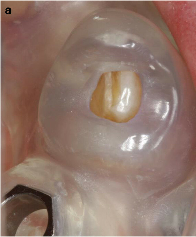 Fig. 8a: Close-up view of the first CAD/CAM guide in situ (tooth- and mucosa-supported) showing the perfect fit on tooth #33 (a). Occlusal view of the second CAD/CAM  guide (implant- and mucosa-supported) after extraction of teeth #42 and 33 and placement of implants in positions #44 and 35 (b). 