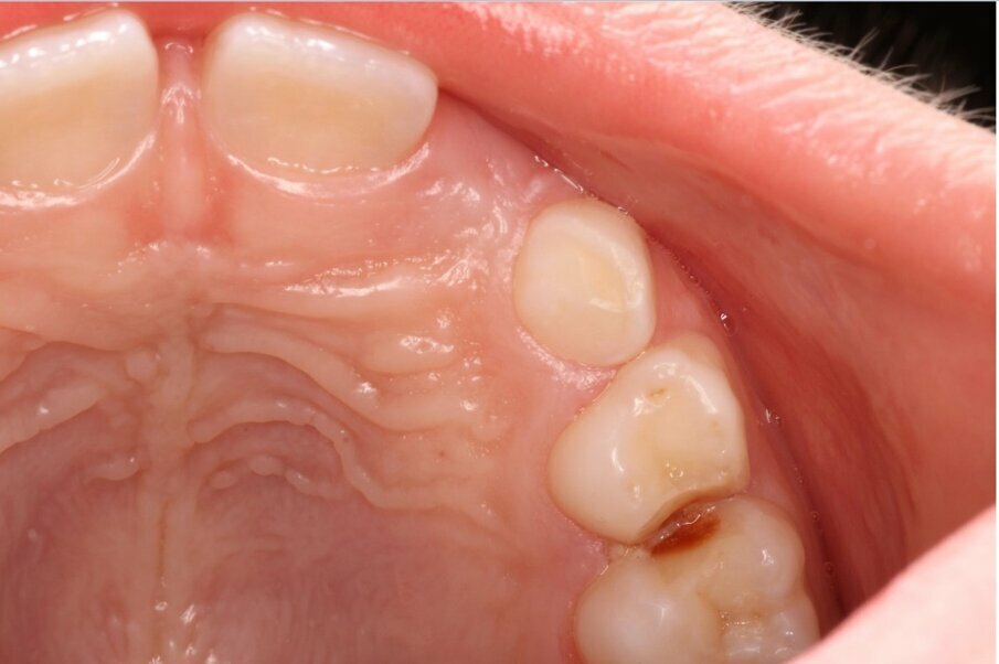 Afbeelding 1b. Beslepen melkmolaren in de bovenkaak (NB het verdient aanbeveling de distale vlakken  schuiner te beslijpen dan de mesiale vlakken in verband met de toegankelijkheid voor de tandenborstel).