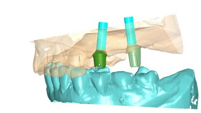 Protesi parziale fissa supportata da impianti nella riabilitazione di edentulie parziali multiple. Il posizionamento implantare “protesicamente guidato”.