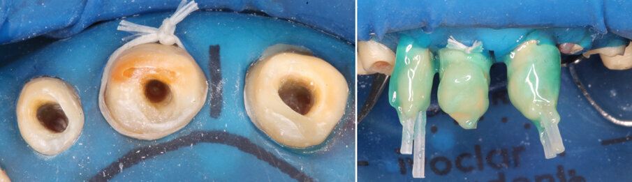 Figs 6 and 7: Build-up of teeth 12, 11, and 21 with endodontic posts made of glass fibre-reinforced composite