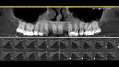 Caso di agenesia dentale trattato con impianti innovativi di diametro ridotto
