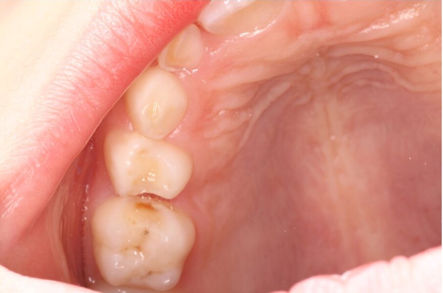Afbeelding 1a. Beslepen melkmolaren in de bovenkaak (NB het verdient aanbeveling de distale vlakken  schuiner te beslijpen dan de mesiale vlakken in verband met de toegankelijkheid voor de tandenborstel).