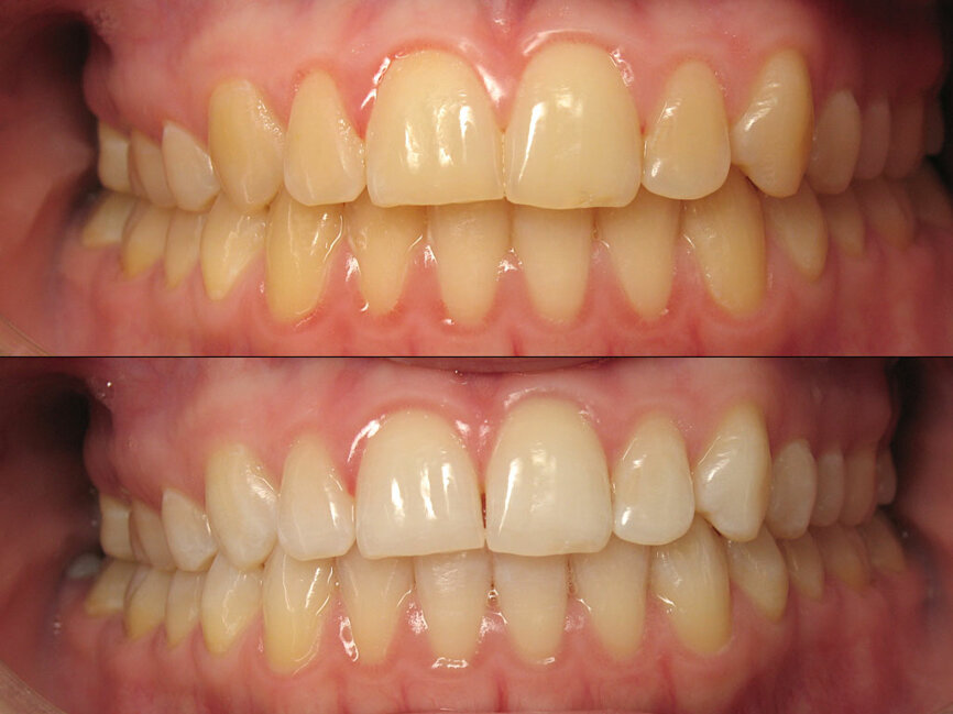 Figura 7. Caso clínico antes y después del blanqueamiento dental en casa con cubetas personalizadas.
