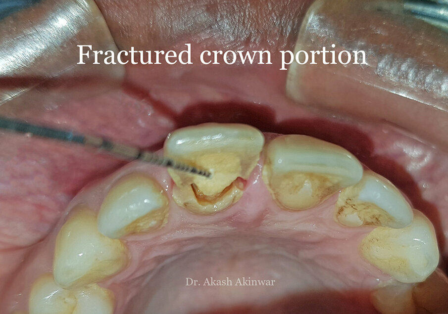 Fig 4: Fractured crown portion