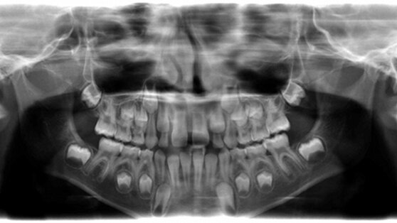 Le futur de l’endodontie : la revascularisation pulpaire