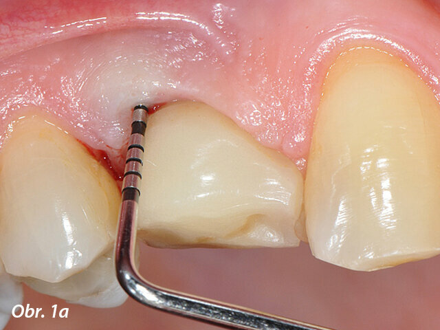 Periimplantitidou postižený implantát v pozici zubu 14 s patrnou patologickou hloubkou sondáže: a) implantát opatřený korunkou