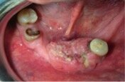 Fig. 3a - Immagine clinica di Carcinoma orale in paziente donna di 86 anni.