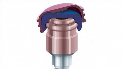 LOCATOR attachment systems for Neodent CM Implants now available through Zest