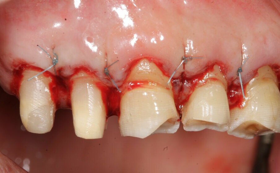 Fig. 5: Sutures after surgical crown lengthening in the maxillary jaw