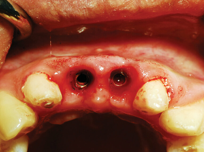 Fig. 9: Uncovery of the implants and healing screws exposed. (Photo provided by Dr. Gregori M. Kurtzman)