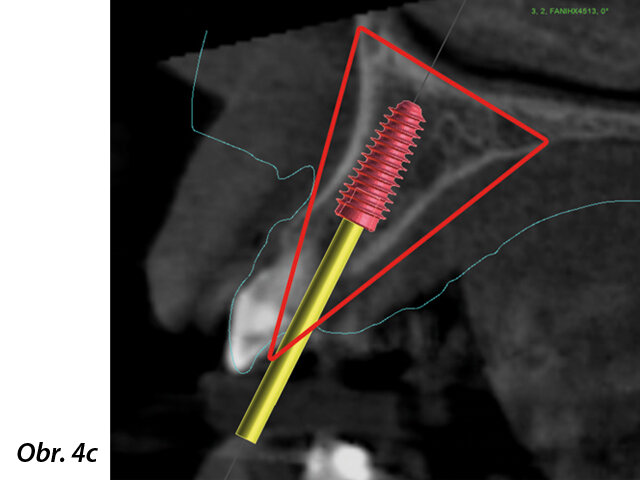 Do zbývajícího alveolu byl na základě protokolu bloku kostního trojúhelníku umístěn implantát vhodné délky a průměru