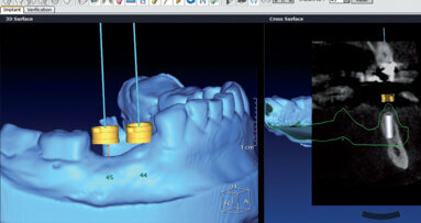 Implantologia digitale: risultati prevedibili estetici e funzionali