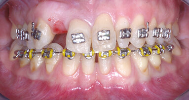 Ritrattamento ortodontico e riabilitazione mediante l’utilizzo di impianto narrow platform in un caso di agenesia di un laterale con spazio medio-distale ridotto
