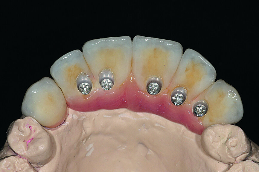 Fig. 35: After fitting of the zirconia framework, the ceramic was cast using the exact parameters validated by the resin prosthesis.