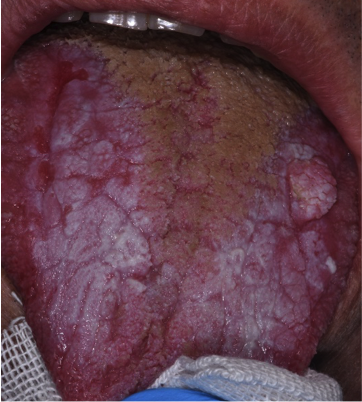 Fig. 1b - Fotografia digitale dello stesso paziente che ha sviluppato un Carcinoma orale, prontamente trattato.