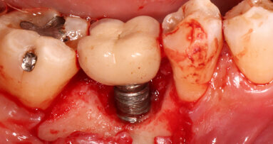 Study determines reasons for dental implant failure and removal techniques
