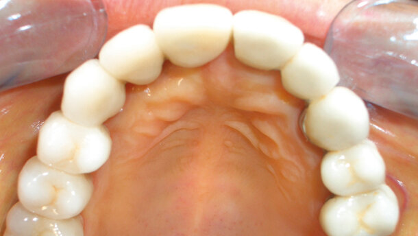 Operatività odontoiatrica o di chirurgia maxillo-facciale nel paziente epatopatico