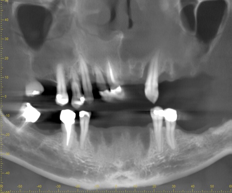 Fig. 2 - Ricostruzione preoperatoria di tipo Panorex che evidenzia un difetto osseo di tipo combinato in mandibola