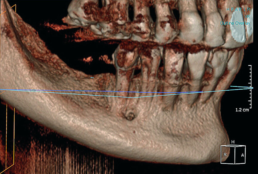 Fig. 13: CBCT reconstruction of a deficient ridge in the lateral mandible.