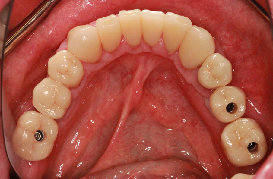 Fig. 27: Screw-retained IPS e.max CAD restorations