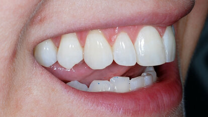 Upper Arch Alignment with  the ClearSmile Inman Aligner