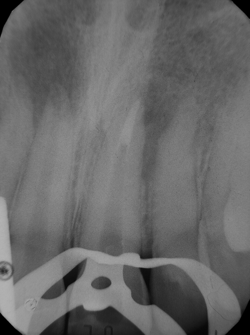 Fig. 2: Intraoperative radiograph of apical plug of tooth #21.