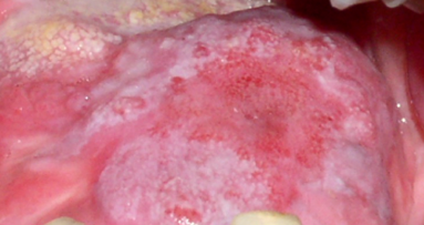 Sustancias coadyuvantes en el manejo de la mucositis oral