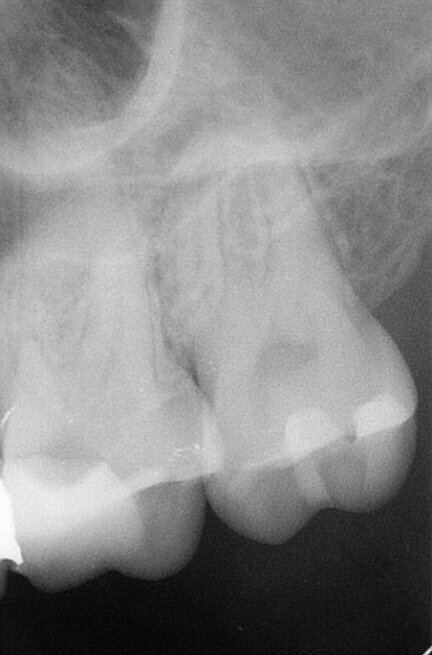 Fig. 2: Initial radiograph.