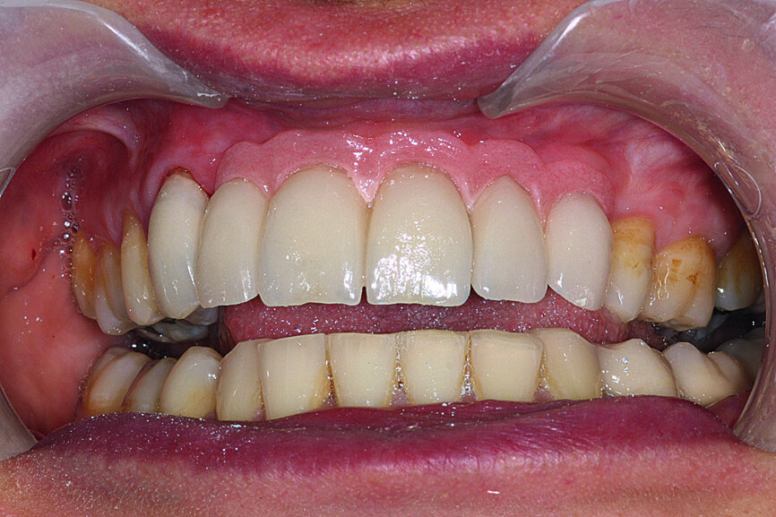 Fig. 28: The prosthesis was attached with screws and the necessary occlusal verification was conducted.