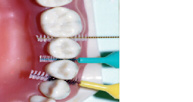 Aktuální koncepty prevence gingivitidy a parodontitidy