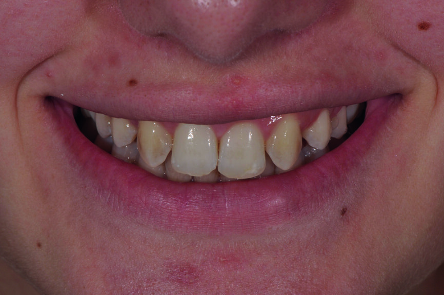 Fig. 1a : Sourire après la fermeture orthodontique. 