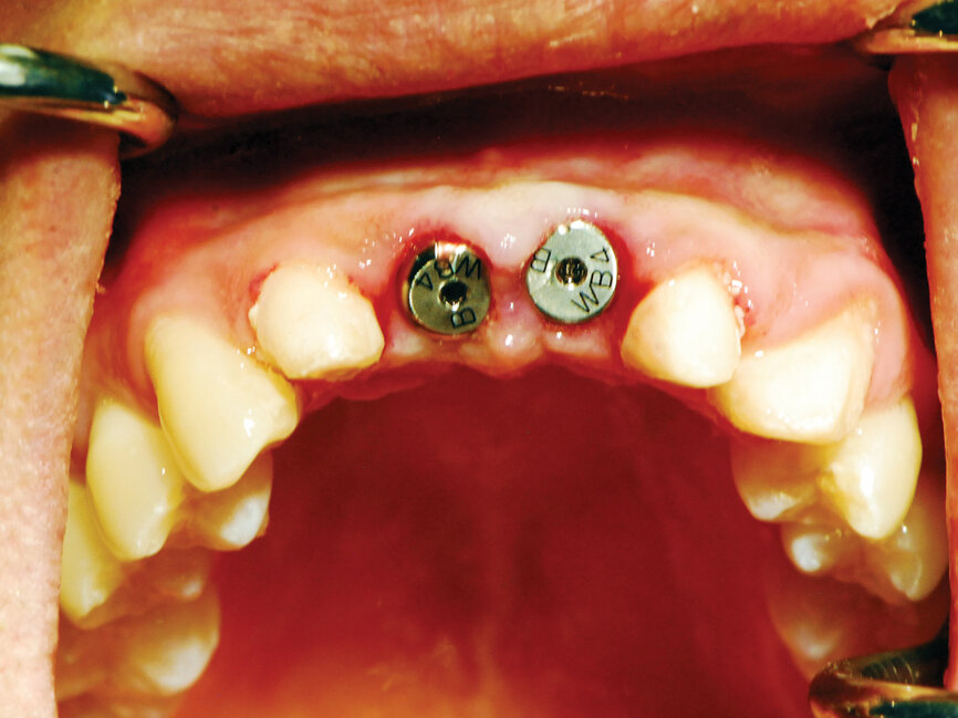 Fig. 10: Healing abutments placed into the implants. (Photo provided by Dr. Gregori M. Kurtzman)